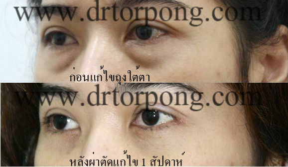 ก่อนและหลังแก้ไขถุงใต้ตา 1 สัปดาห์ ก่อนและหลังแก้ไขถุงใต้ตา 1 สัปดาห์