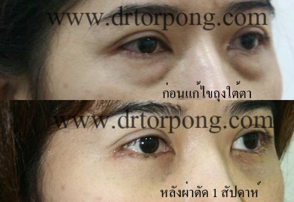 ก่อนและหลังแก้ไขถุงใต้ตา 1 สัปดาห์ ก่อนและหลังแก้ไขถุงใต้ตา 1 สัปดาห์
